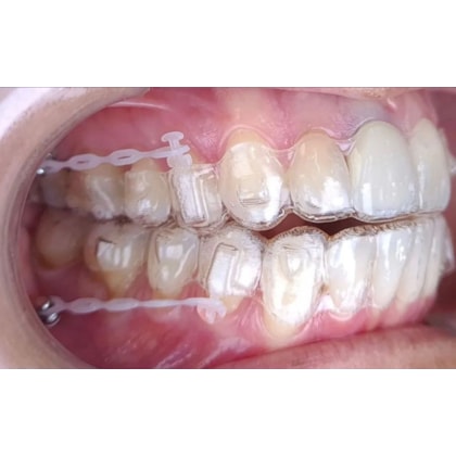 Botão Power Arm Cerâmico | Infinity | Orthoghia