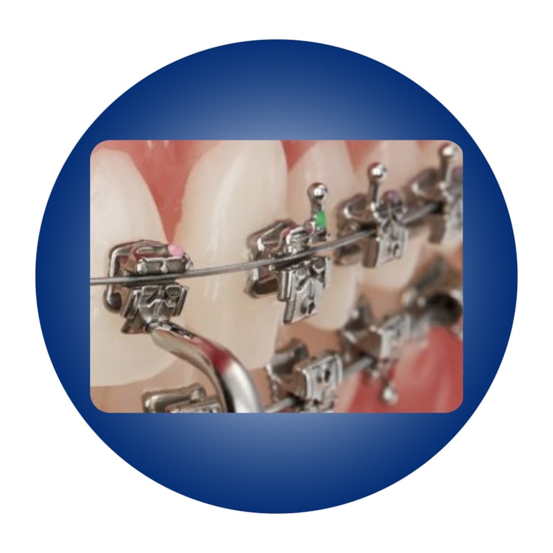 Bracket AutoLigado Carriere SLX 022 5x5 Orthoghia