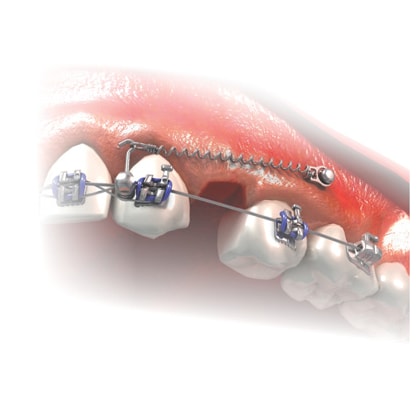 Miniparafuso Ortodôntico (Compr.: 6mm Transm.: 1mm Ø1.5mm)