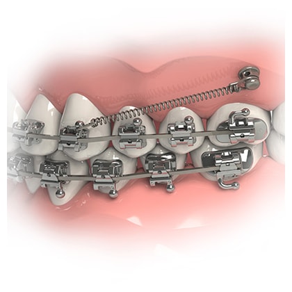 Miniparafuso Ortodôntico Extrarradicular de Aço (Compr.: 10mm Transm.: 4mm Ø2mm)
