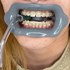 Oralis - Afastador de labios, língua com apoio sugador