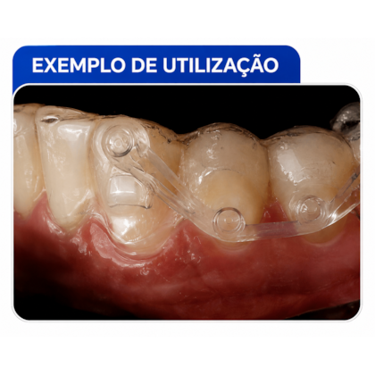 Resina Bond Aligner