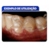 Resina Bond Aligner